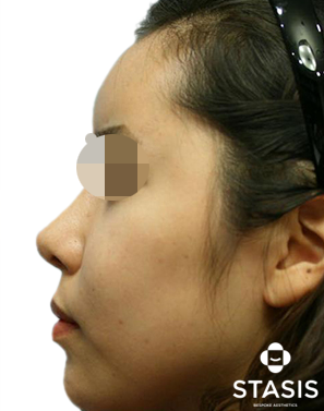 Nose Dermal Filler after image