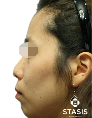 Nose Dermal Filler before image