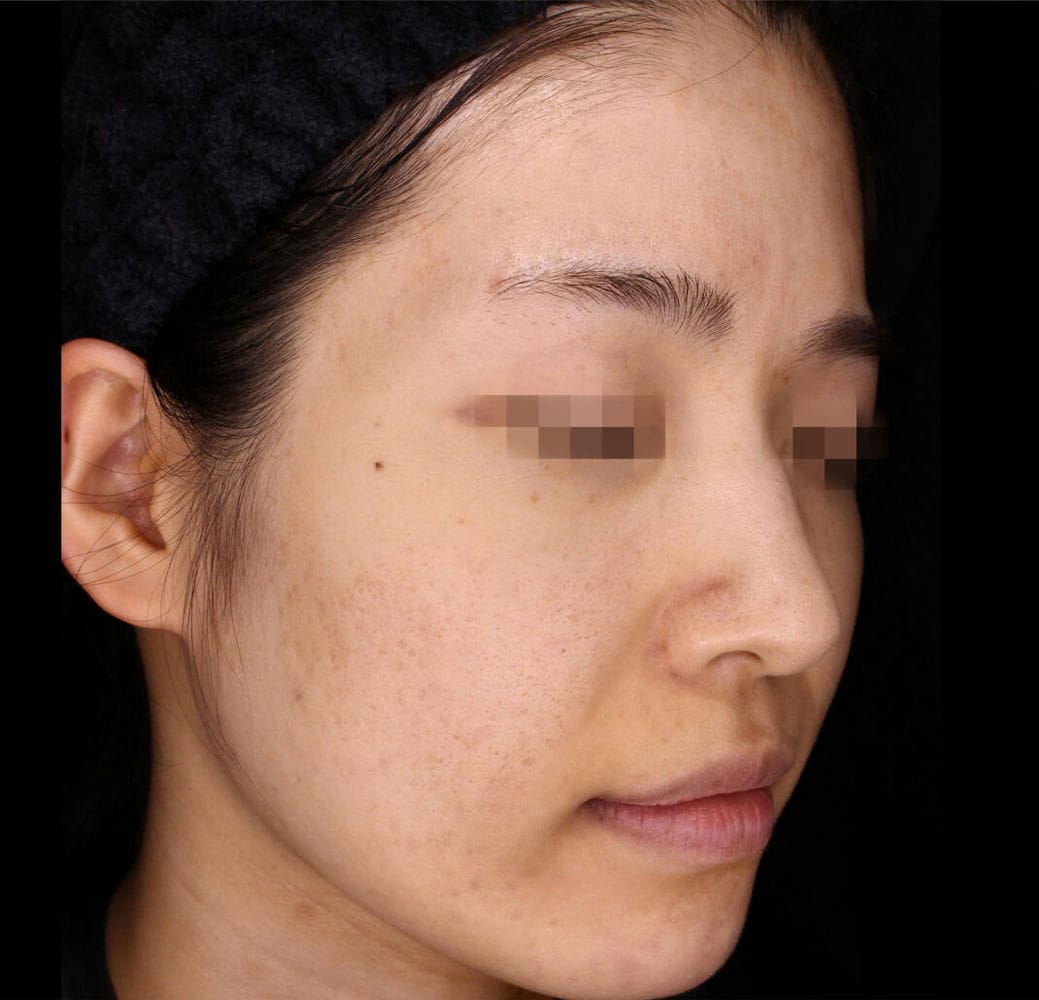 Non-invasive-10 after image