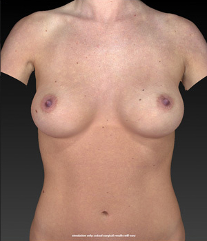 breast-contouring after image