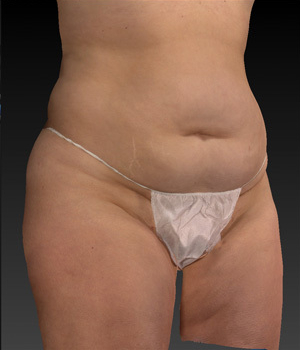 body-contouring before image