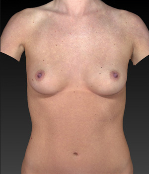 breast-contouring before image