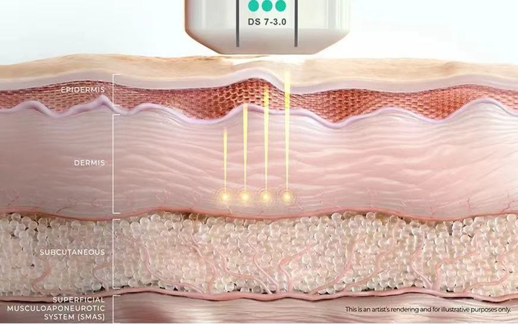 https://stasisclinic.com/ultherapy-prime-in-your-40s-is-it-the-right-skin-lifting-solution-in-sydney/